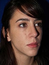 Rhinoplasty Before & After