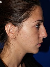 Rhinoplasty Before & After