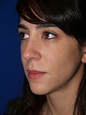 Rhinoplasty Before & After