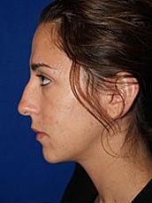 Rhinoplasty Before & After