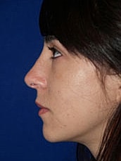 Rhinoplasty Before & After