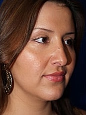 Rhinoplasty Before & After