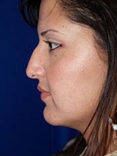 Rhinoplasty Before & After