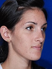 Rhinoplasty Before & After