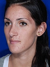 Rhinoplasty Before & After