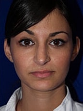 Rhinoplasty Before & After