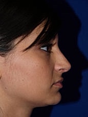 Rhinoplasty Before & After