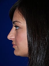 Rhinoplasty Before & After