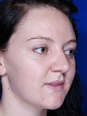 Rhinoplasty Before & After