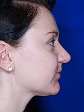 Rhinoplasty Before & After