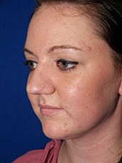 Rhinoplasty Before & After