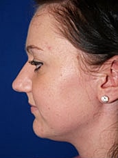 Rhinoplasty Before & After