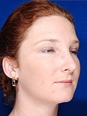 Rhinoplasty Before & After
