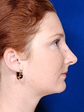 Rhinoplasty Before & After