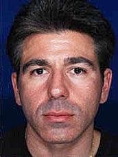 Rhinoplasty Before & After