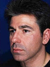 Rhinoplasty Before & After