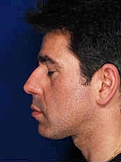 Rhinoplasty Before & After