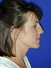 Rhinoplasty Before & After