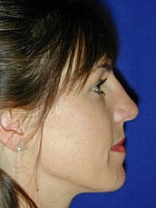 Rhinoplasty Before & After