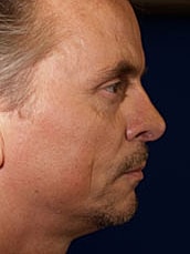 Rhinoplasty Before & After