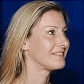 Rhinoplasty Before & After