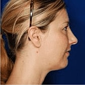 Rhinoplasty Before & After