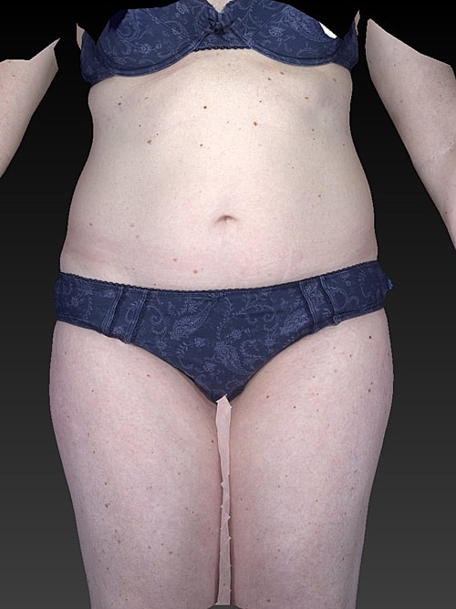 Tummy Tuck Before & After