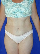 Tummy Tuck Before & After
