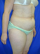 Tummy Tuck Before & After