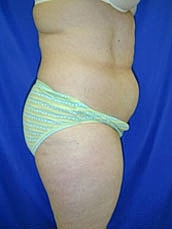 Tummy Tuck Before & After