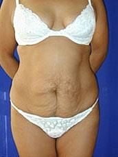 Tummy Tuck Before & After