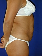 Tummy Tuck Before & After