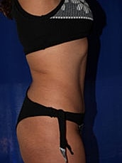 Tummy Tuck Before & After