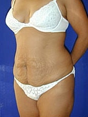Tummy Tuck Before & After