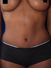 Tummy Tuck Before & After