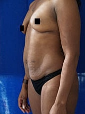 Tummy Tuck Before & After