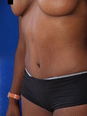 Tummy Tuck Before & After