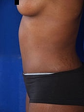 Tummy Tuck Before & After