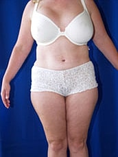 Tummy Tuck Before & After
