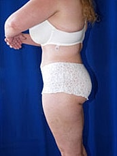 Tummy Tuck Before & After