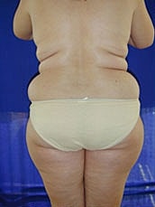 Tummy Tuck Before & After
