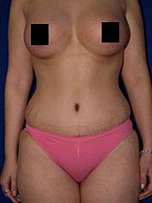 Tummy Tuck Before & After