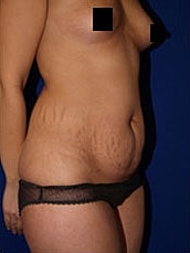 Tummy Tuck Before & After