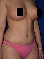 Tummy Tuck Before & After