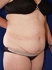 Tummy Tuck Before & After