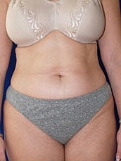 Tummy Tuck Before & After