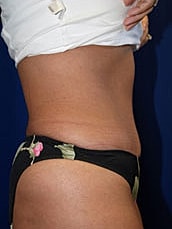 Tummy Tuck Before & After