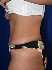 Tummy Tuck Before & After