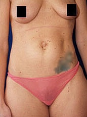 Tummy Tuck Before & After