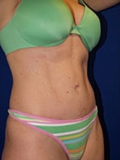 Tummy Tuck Before & After